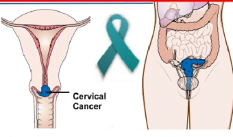 10-warning-signs-of-cervical-cancer-you-shouldne28099t-ignore-8085606