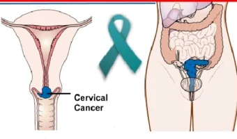 10-warning-signs-of-cervical-cancer-you-shouldne28099t-ignore-8085606