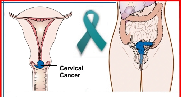 10-warning-signs-of-cervical-cancer-you-shouldne28099t-ignore-8085606
