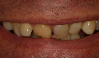 do-not-ignore-these-5-silent-symptoms-for-severe-health-3256355