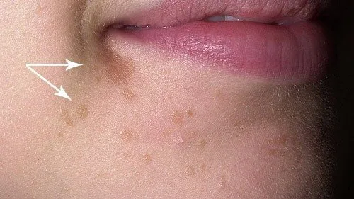 remove-small-warts
