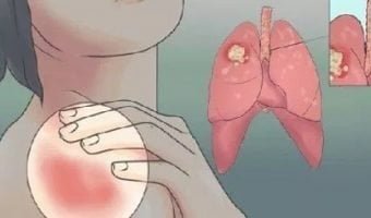 20-Early-Warning-Signs-Of-Lung-Cancer