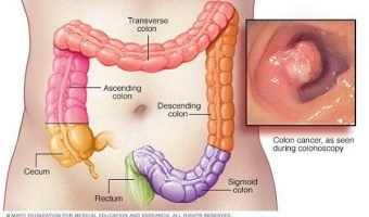 Colon-Cancer-Deaths-Could-Be-Avoided