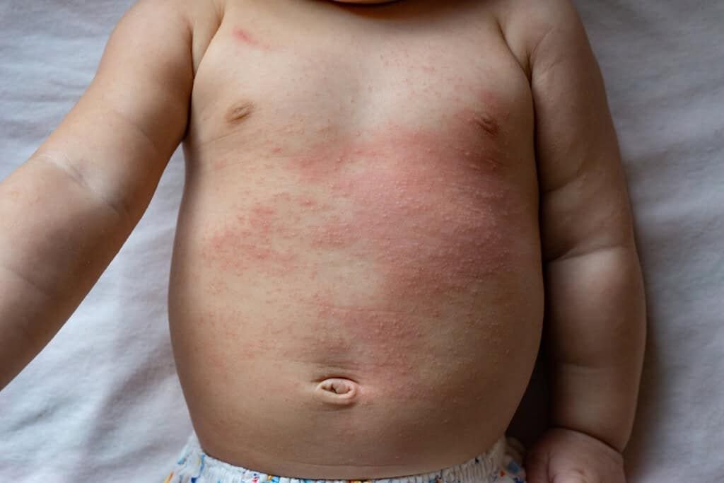 Atopic dermatitis