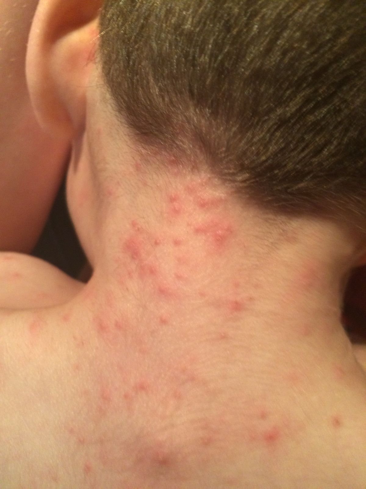 Atopic dermatitis